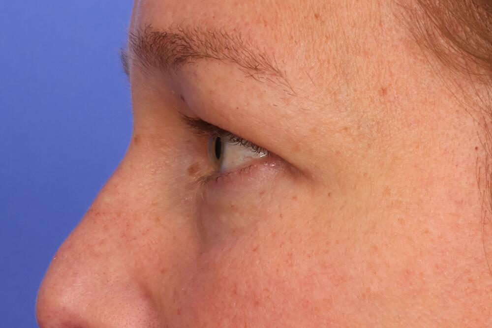 Blepharoplasty Before & After Image