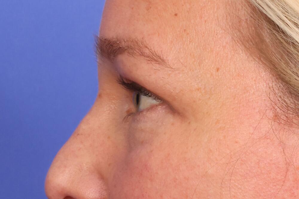 Blepharoplasty Before & After Image