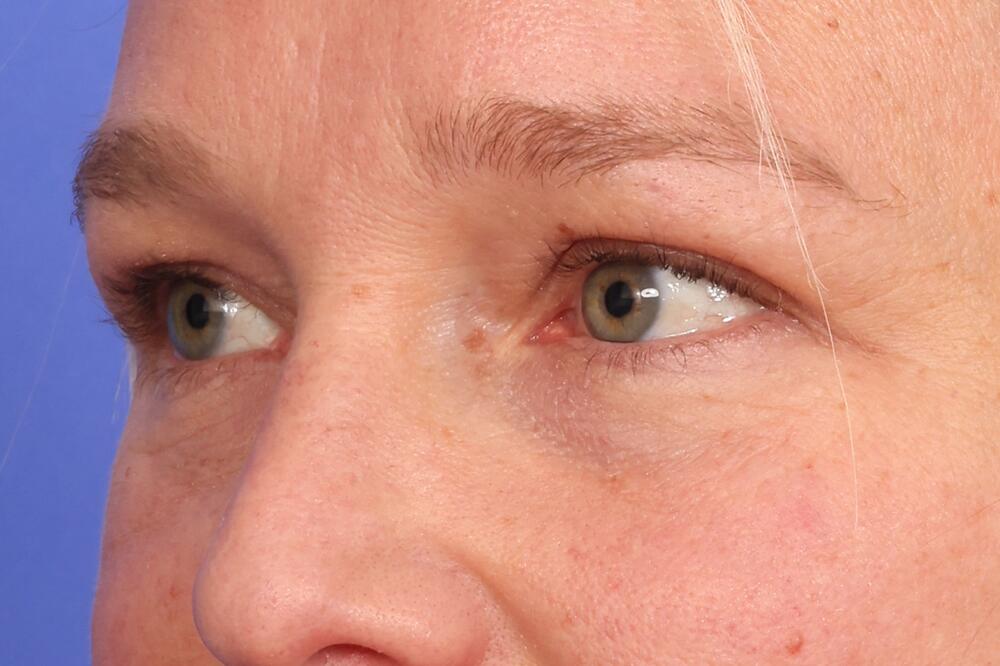 Blepharoplasty Before & After Image