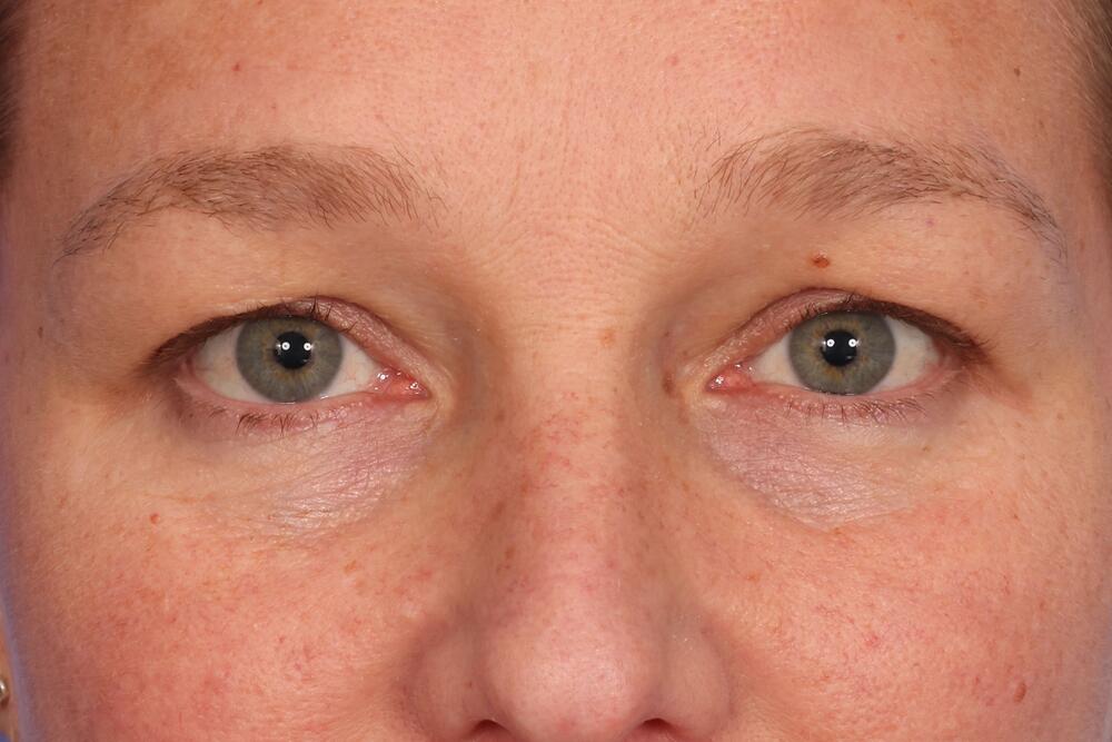 Blepharoplasty Before & After Image