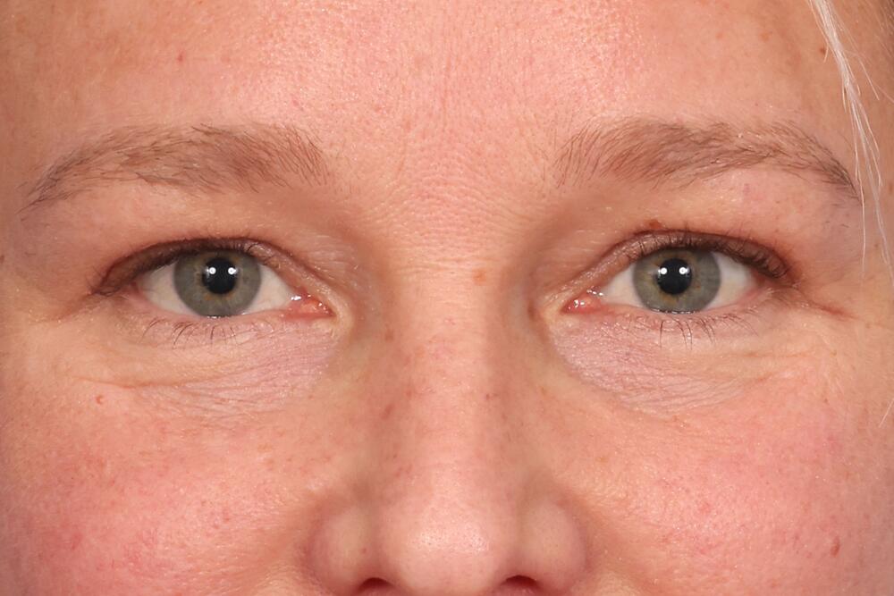 Blepharoplasty Before & After Image