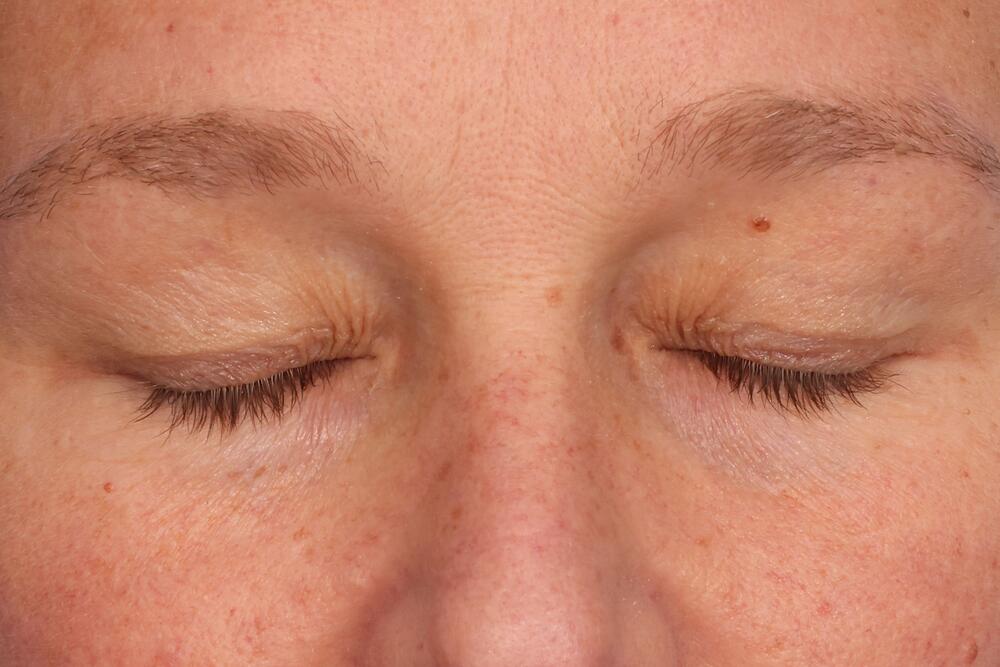 Blepharoplasty Before & After Image