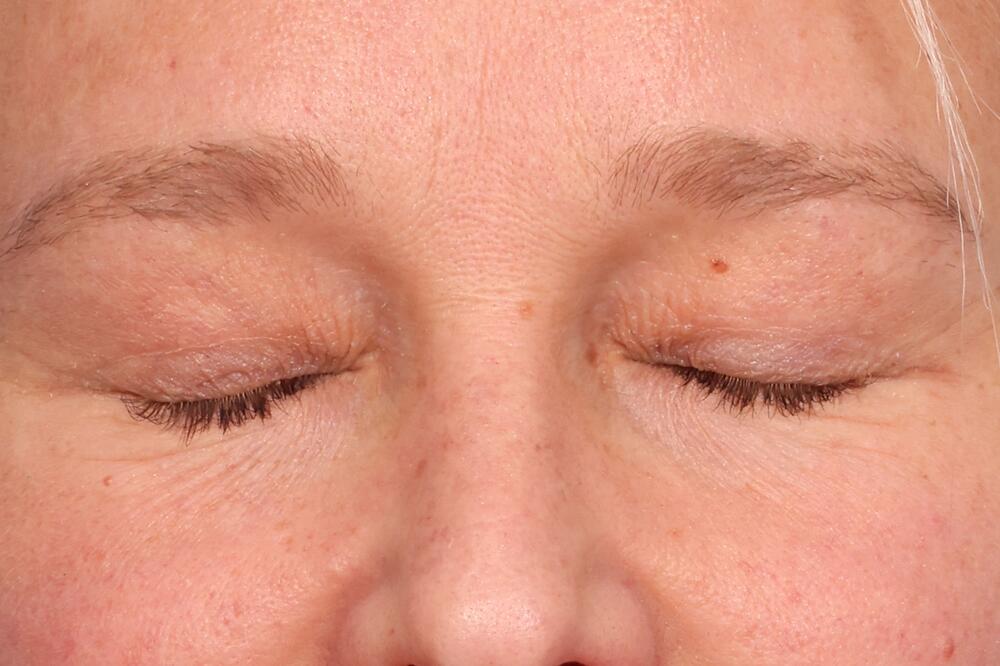 Blepharoplasty Before & After Image