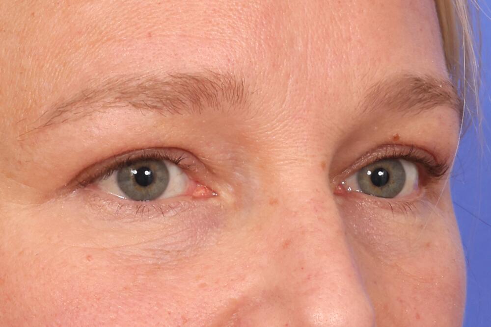 Blepharoplasty Before & After Image