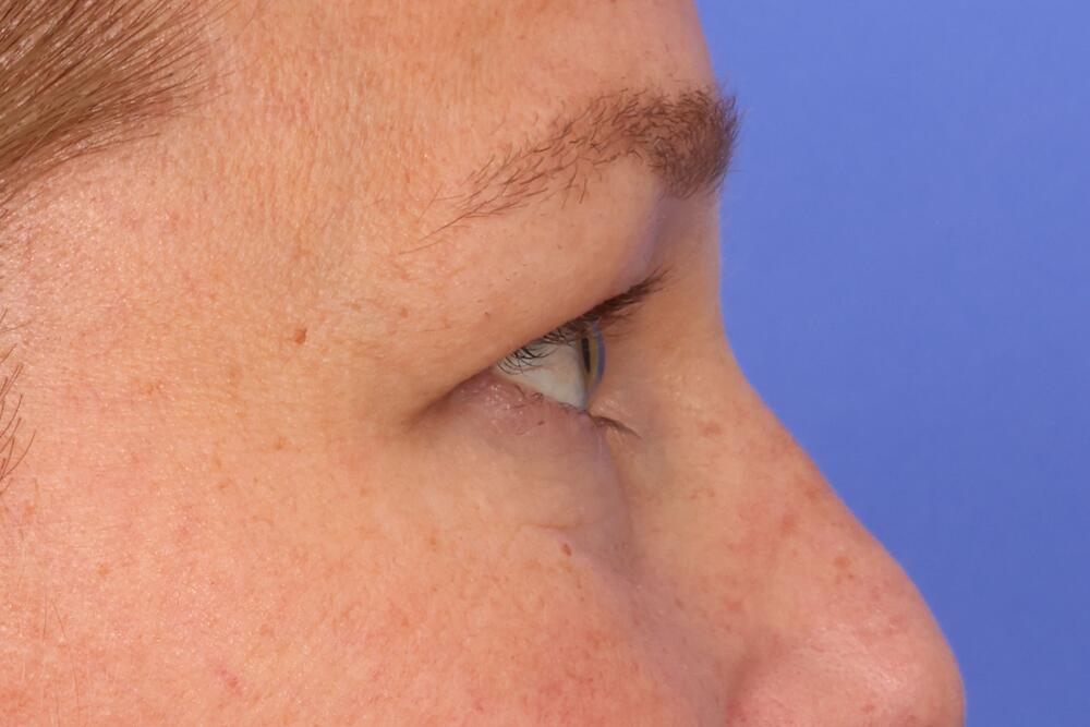 Blepharoplasty Before & After Image