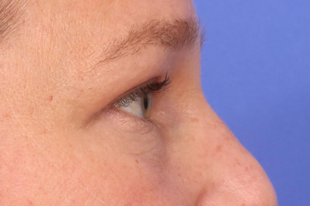 Blepharoplasty Before & After Image