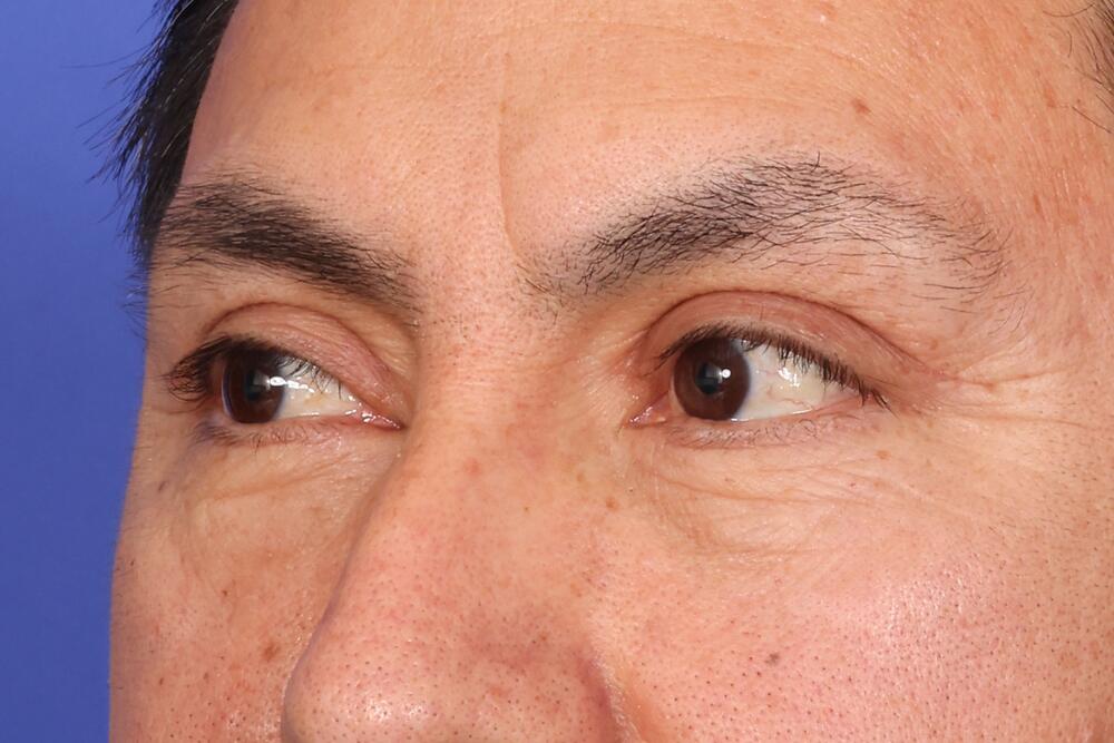 Blepharoplasty Before & After Image