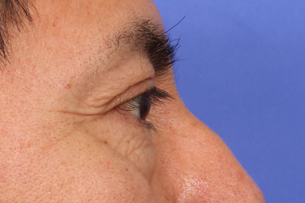 Blepharoplasty Before & After Image