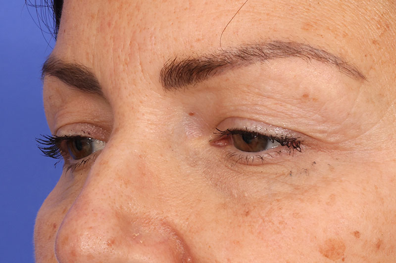 Blepharoplasty Before & After Image
