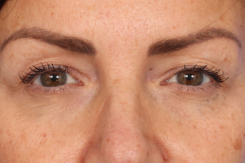 Blepharoplasty Before & After Image