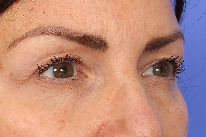 Blepharoplasty Before & After Image