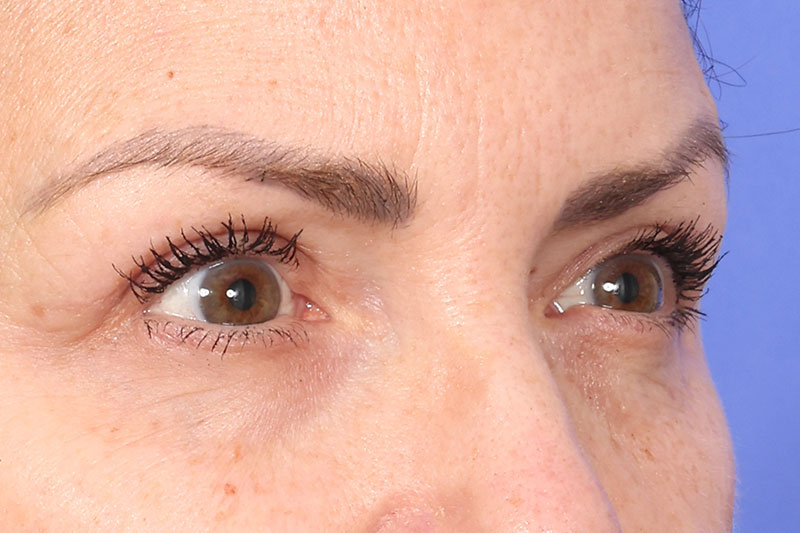 Blepharoplasty Before & After Image