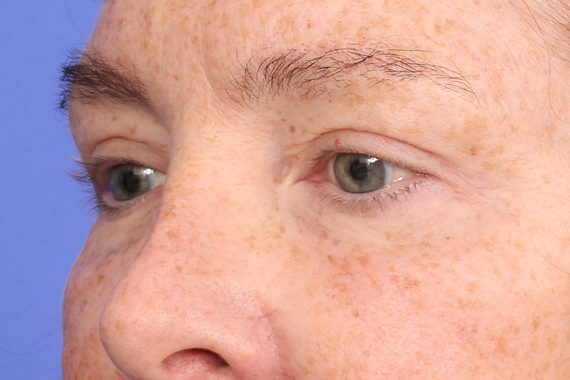 Blepharoplasty Before & After Image