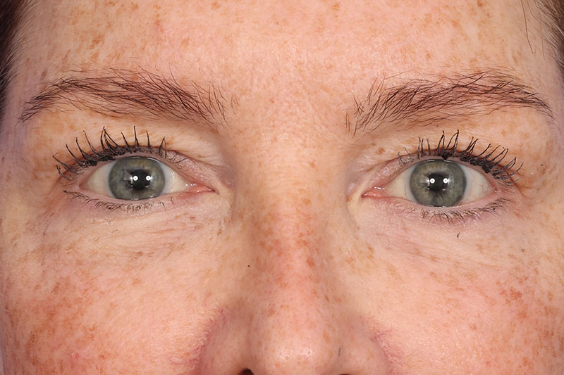 Blepharoplasty Before & After Image