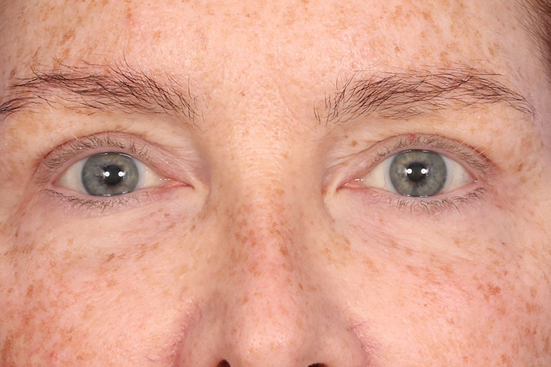 Blepharoplasty Before & After Image
