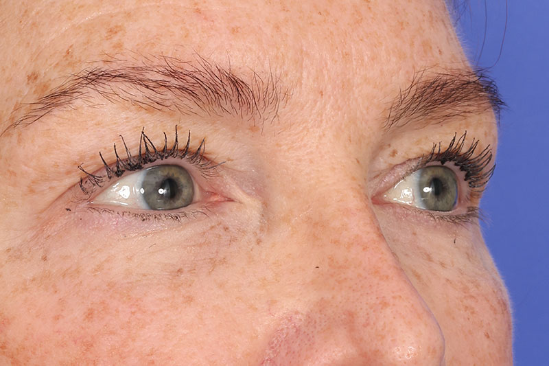 Blepharoplasty Before & After Image