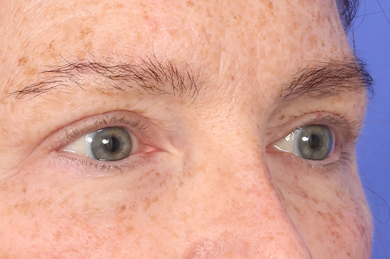 Blepharoplasty Before & After Image