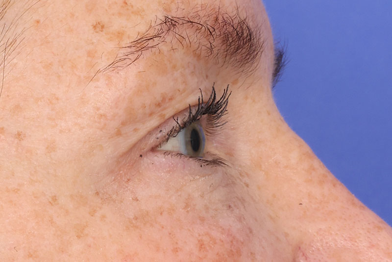 Blepharoplasty Before & After Image