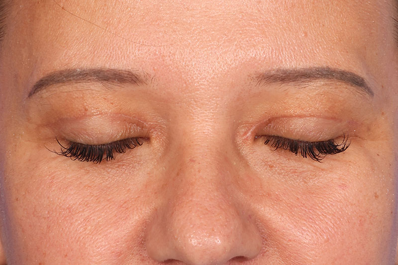 Blepharoplasty Before & After Image