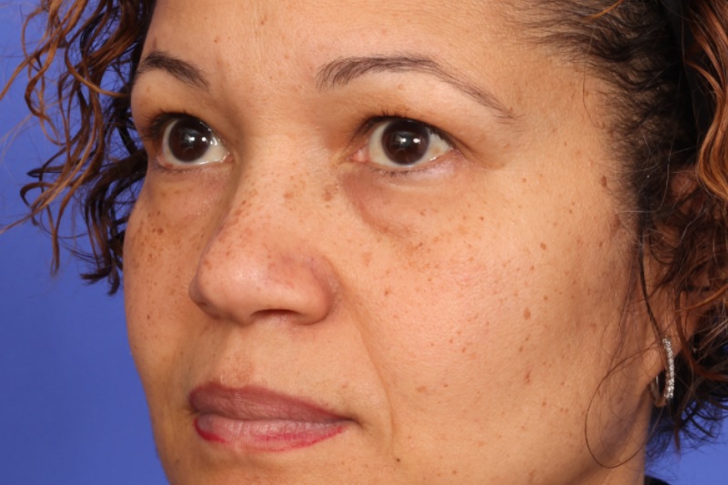 Blepharoplasty Before & After Image