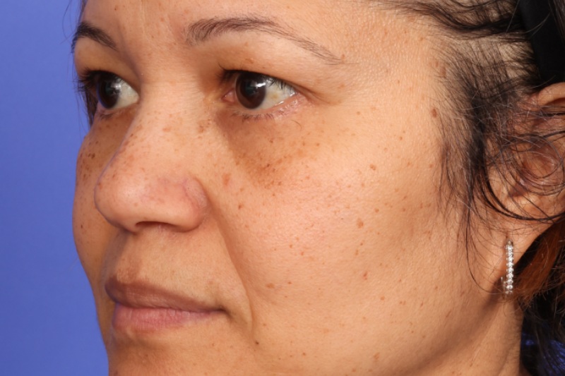 Blepharoplasty Before & After Image