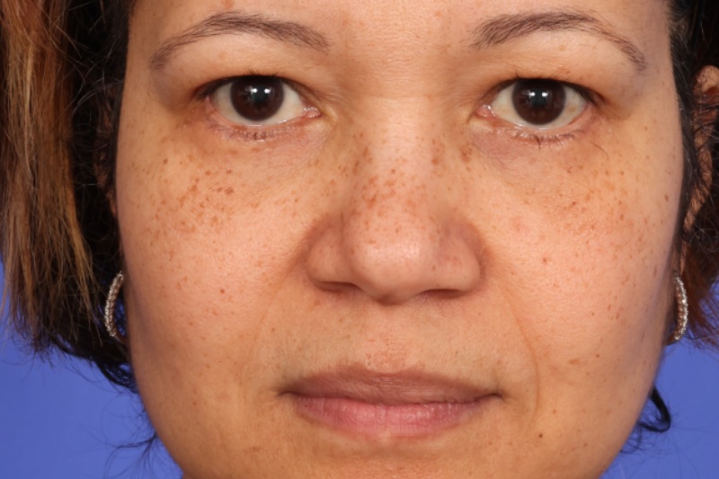 Blepharoplasty Before & After Image