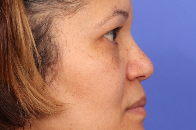 Blepharoplasty Before & After Image
