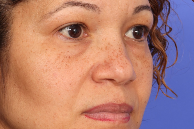 Blepharoplasty Before & After Image