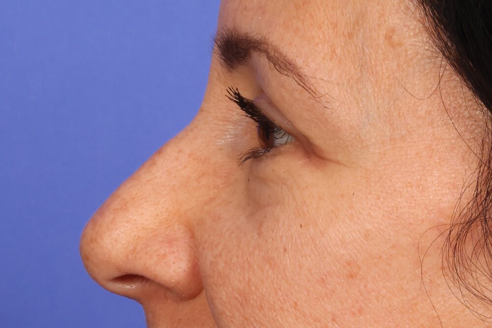 Blepharoplasty Before & After Image