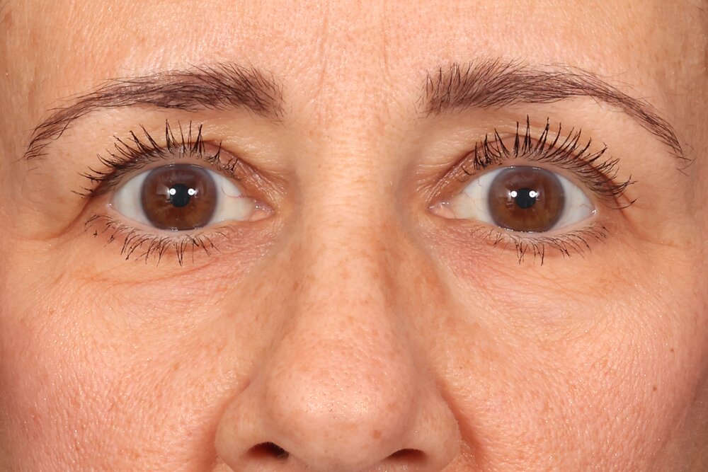 Blepharoplasty Before & After Image