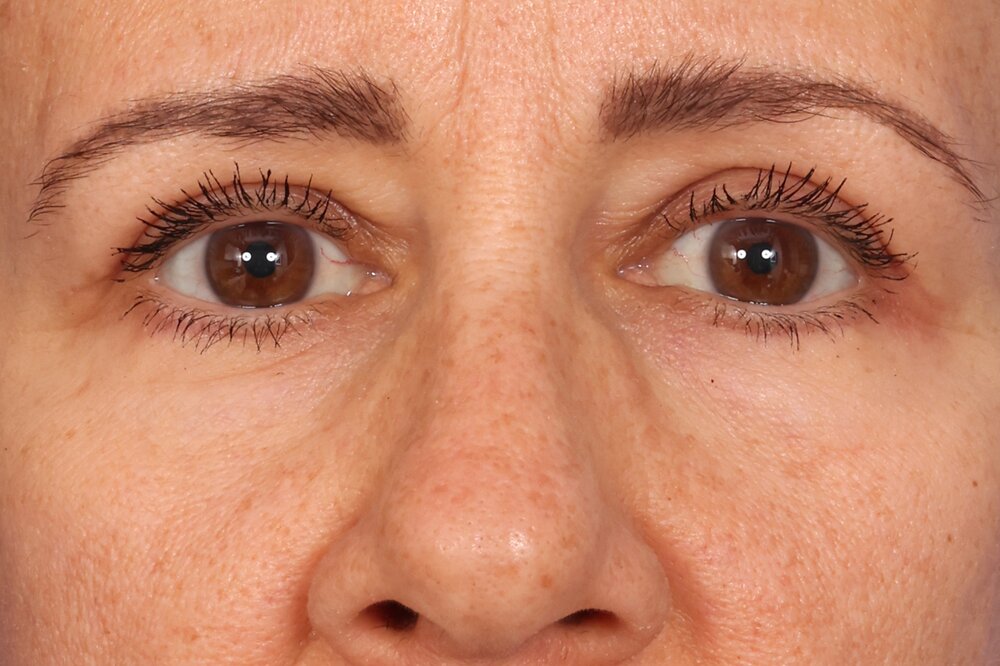 Blepharoplasty Before & After Image