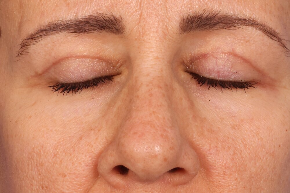 Blepharoplasty Before & After Image
