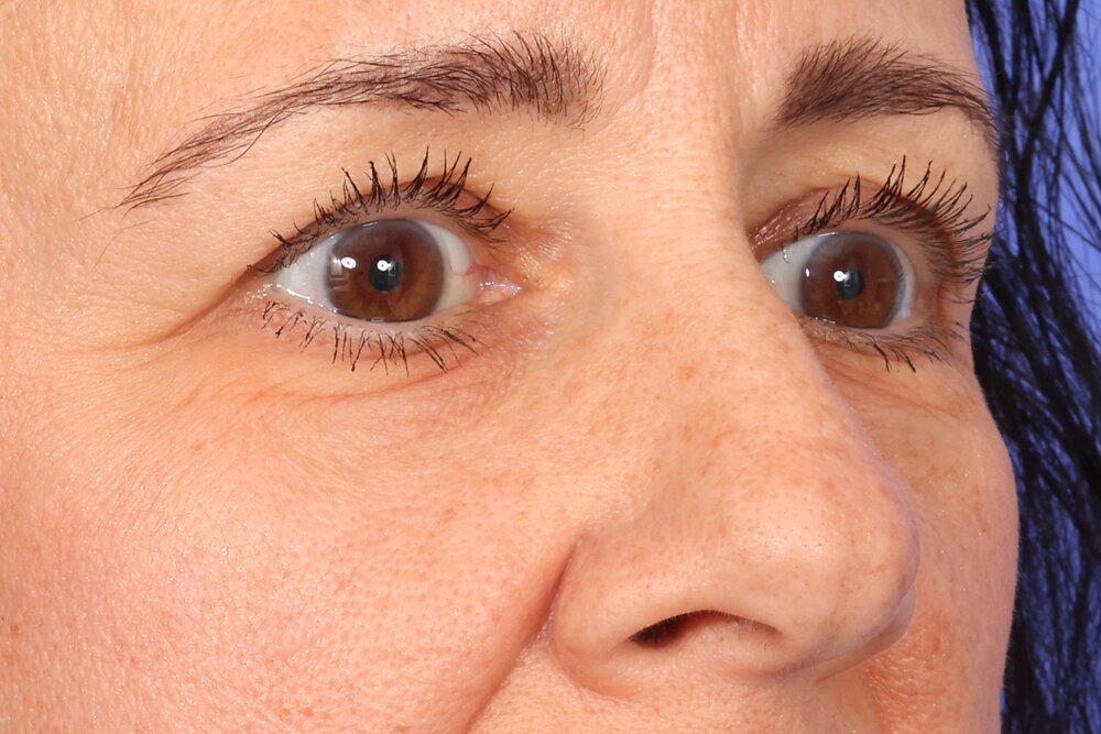 Blepharoplasty Before & After Image