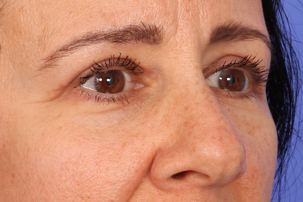 Blepharoplasty Before & After Image