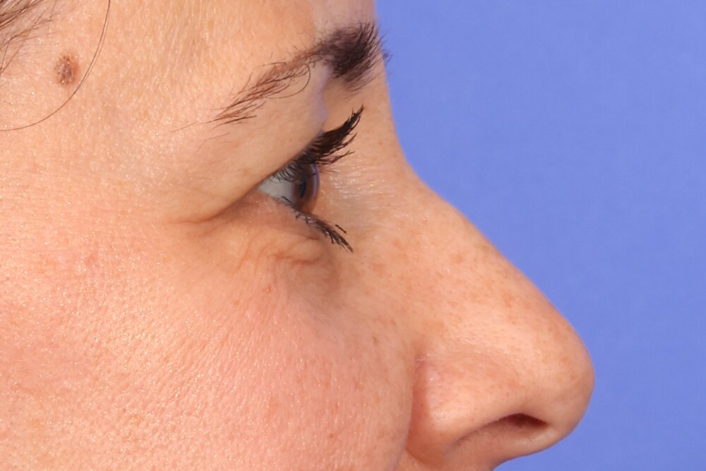 Blepharoplasty Before & After Image