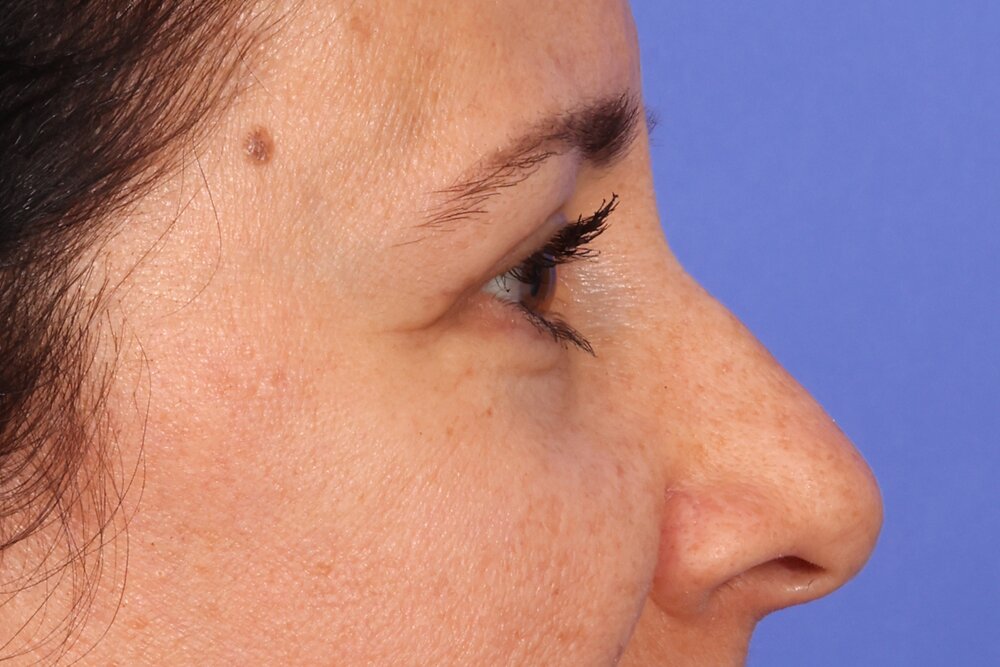 Blepharoplasty Before & After Image