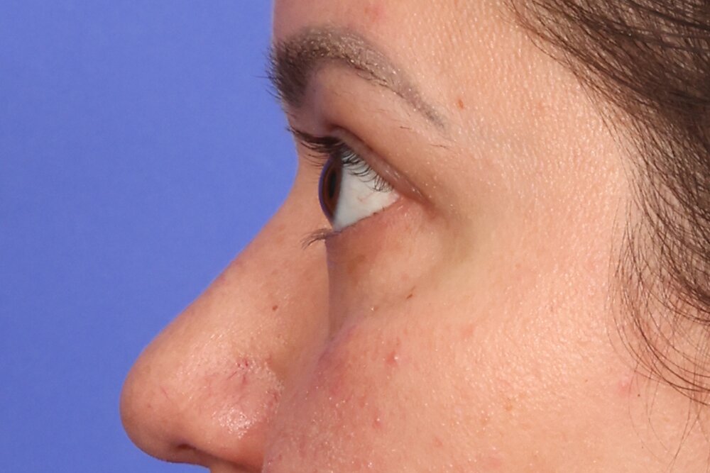 Blepharoplasty Before & After Image