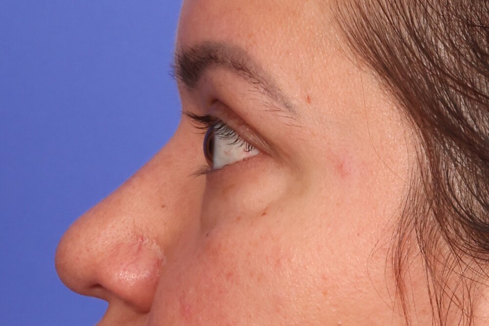 Blepharoplasty Before & After Image