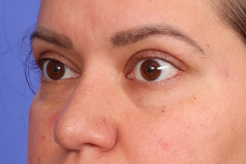 Blepharoplasty Before & After Image
