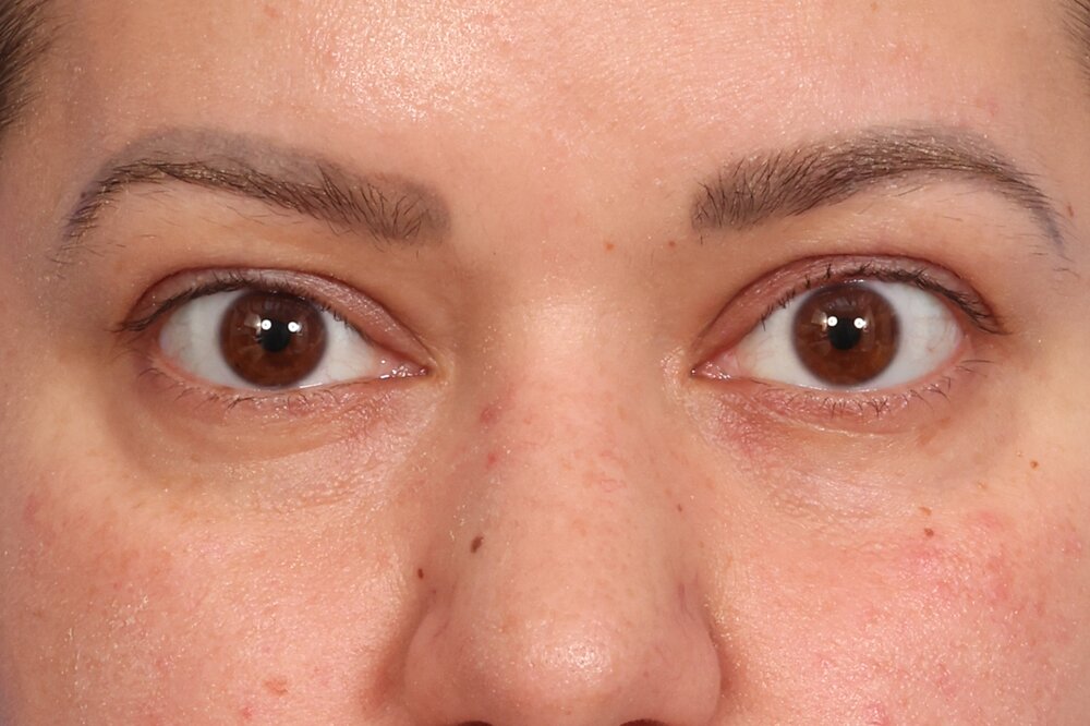 Blepharoplasty Before & After Image