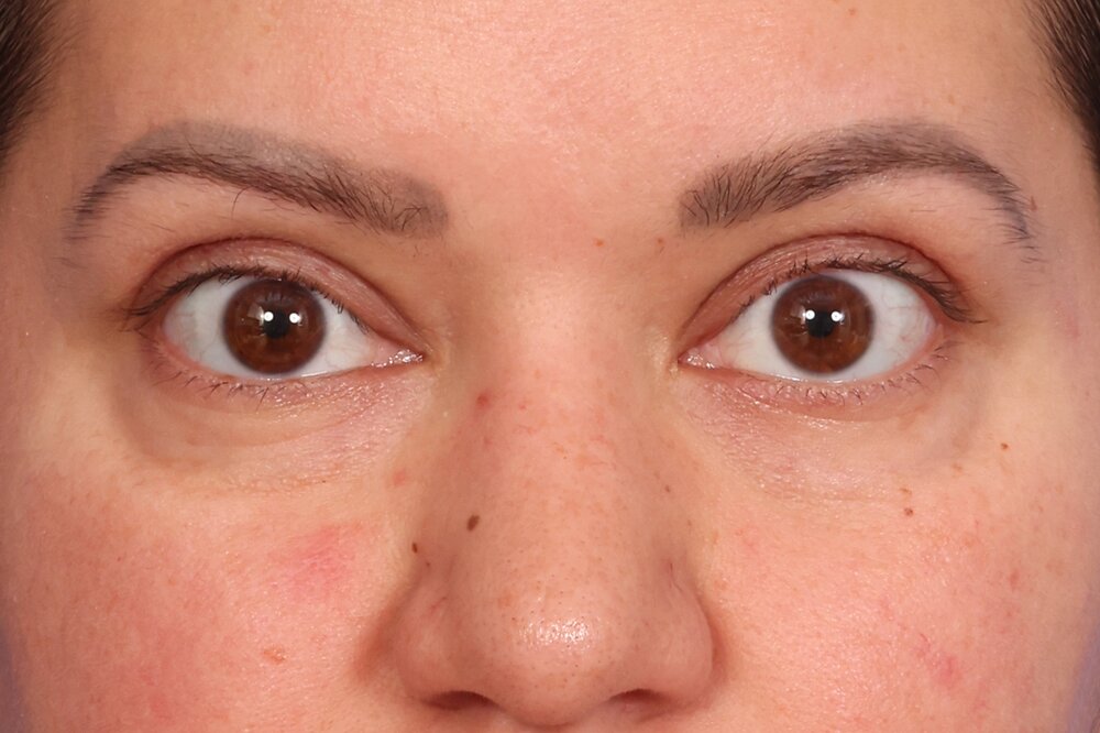 Blepharoplasty Before & After Image
