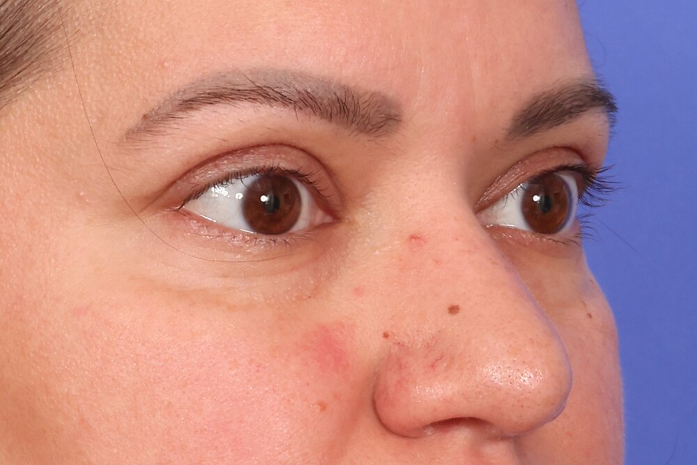 Blepharoplasty Before & After Image