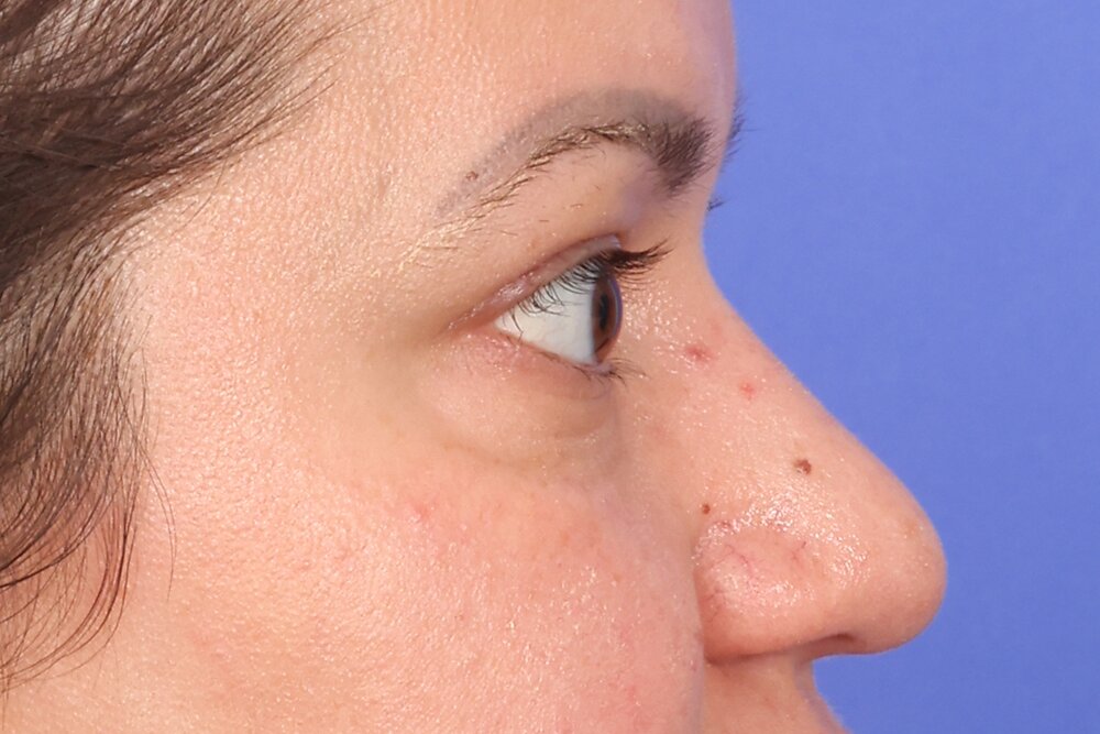 Blepharoplasty Before & After Image