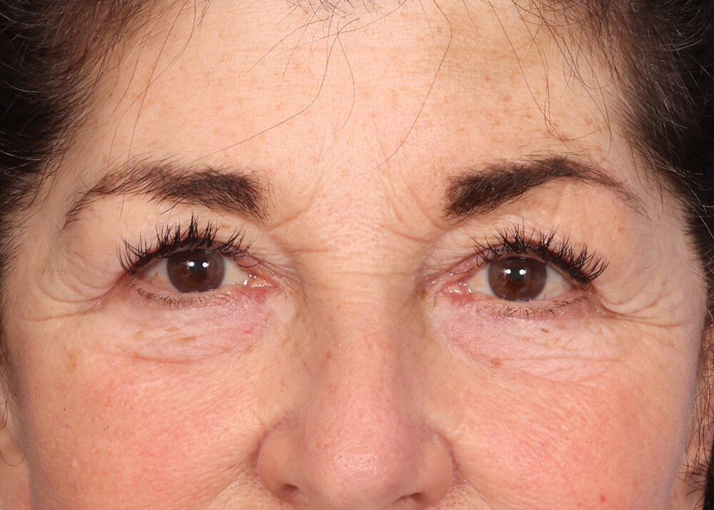 Blepharoplasty Before & After Image