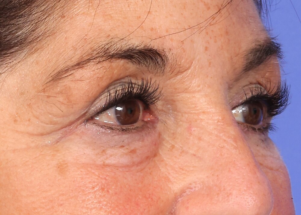 Blepharoplasty Before & After Image