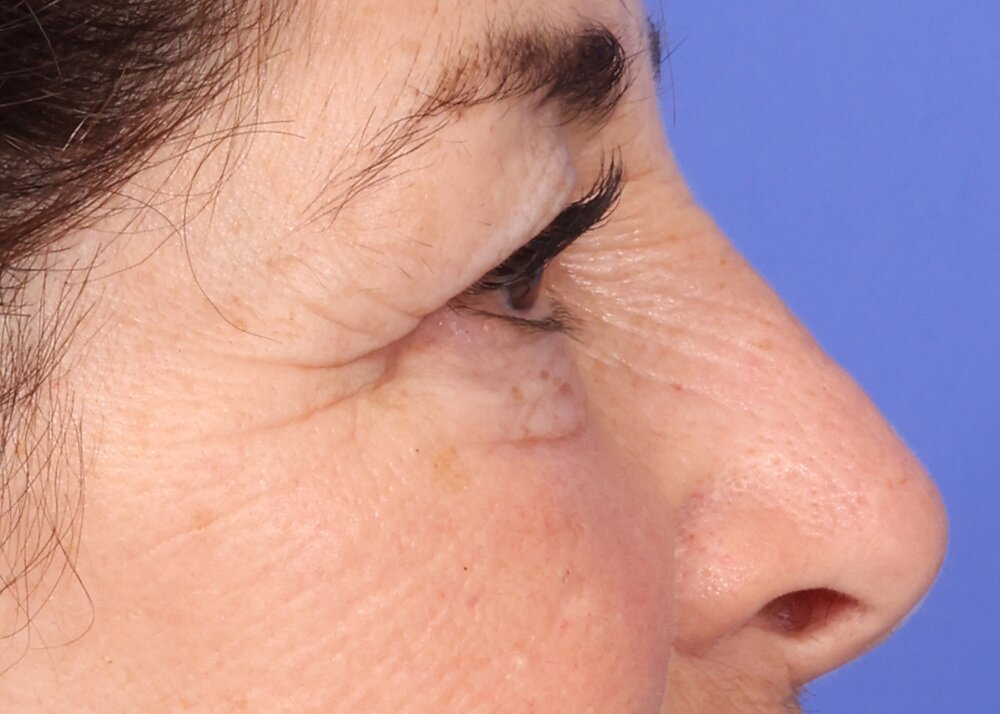 Blepharoplasty Before & After Image