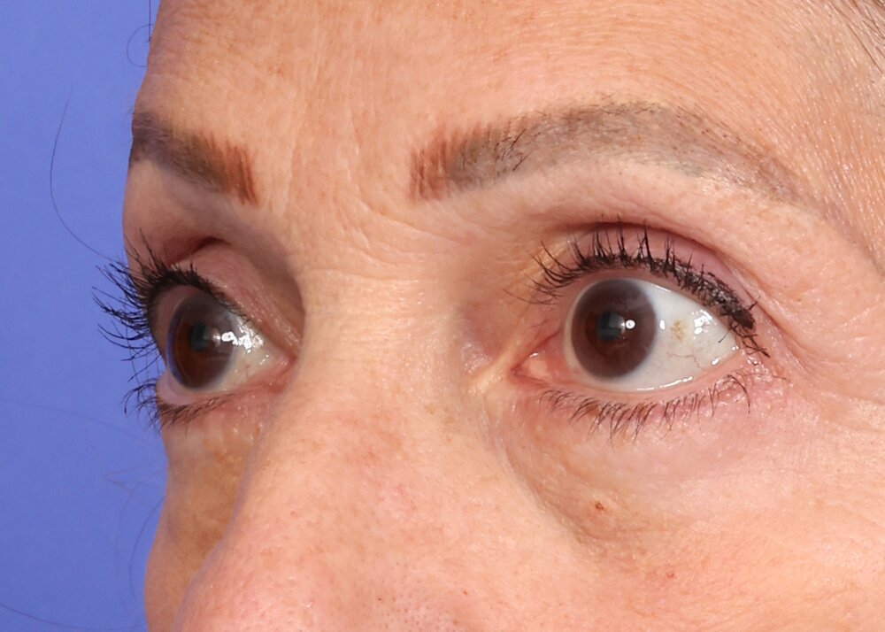 Blepharoplasty Before & After Image