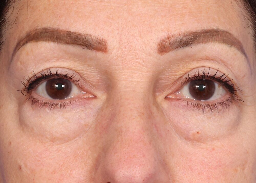 Blepharoplasty Before & After Image