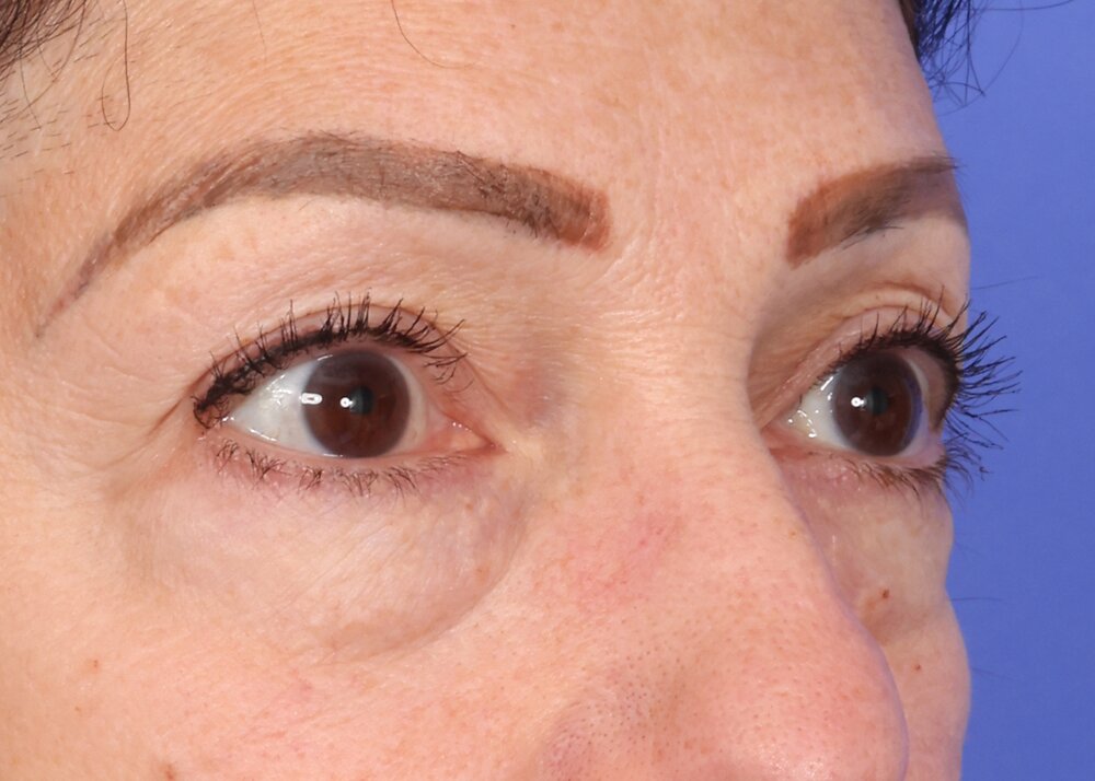 Blepharoplasty Before & After Image