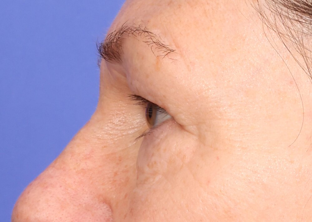 Blepharoplasty Before & After Image